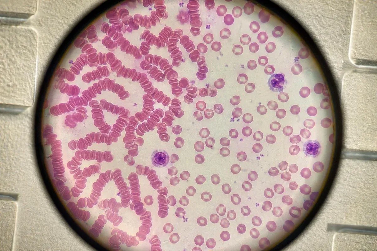 අවසාදන නලයක අතිශයෝක්තියෙන් පෙන්වන ප්ලාස්මා තීරුවක් සමඟ ඉතා ඉහළ ESR දෘශ්‍යමාන කිරීම