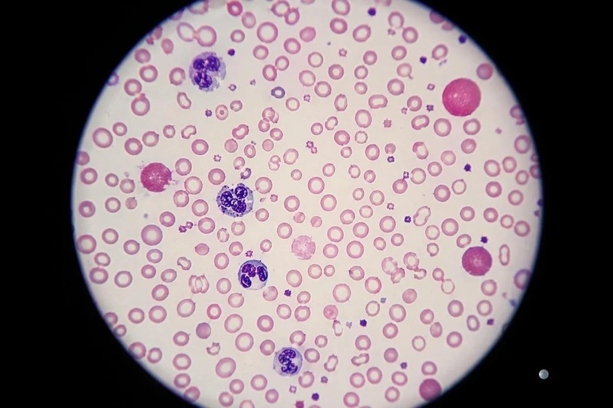Blood test for irregular heartbeat with cellular elements showing anemia-related strain
