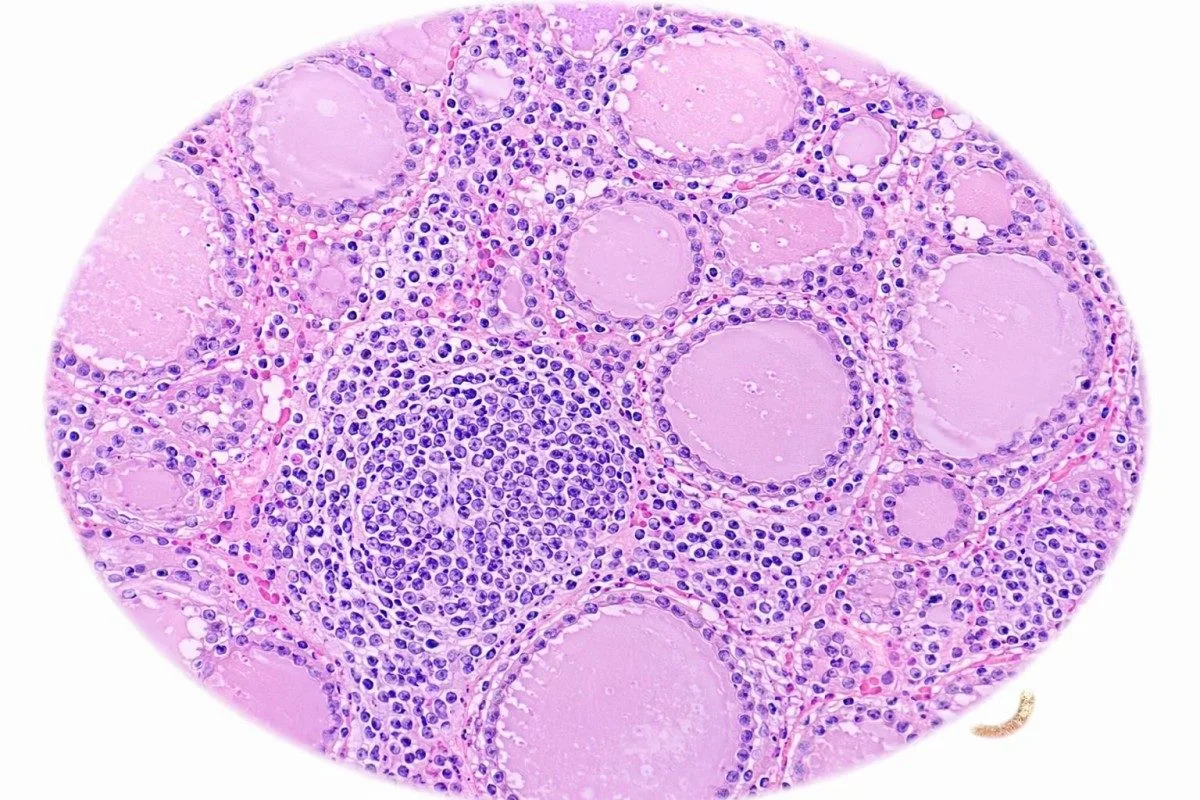 bilan sanguin d’une maladie thyroïdienne : follicules thyroïdiens au microscope avec réponse cellulaire auto-immune