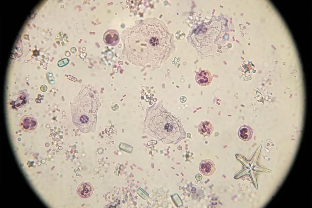 Tabella del colore delle urine con urine torbide e sedimento microscopico usato per la valutazione di un’IVU