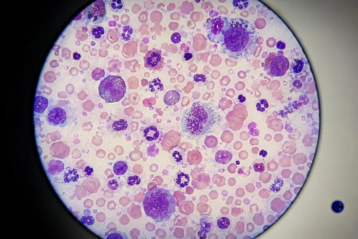 AI-mønsteranalyse af laboratoriedata til blodprøveresultater ved sløret syn