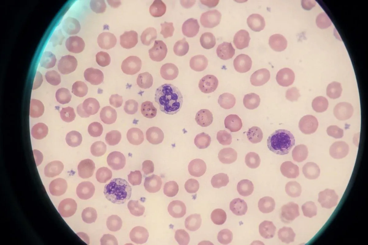 Lead blood test family tracking board with multiple anonymized lab timelines