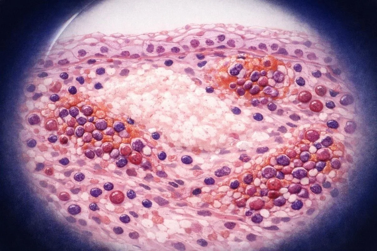 CRP, kompletna krvna slika, biohemijski panel i mokraćna kiselina raspoređeni pored materijala za testiranje reumatoidnog faktora