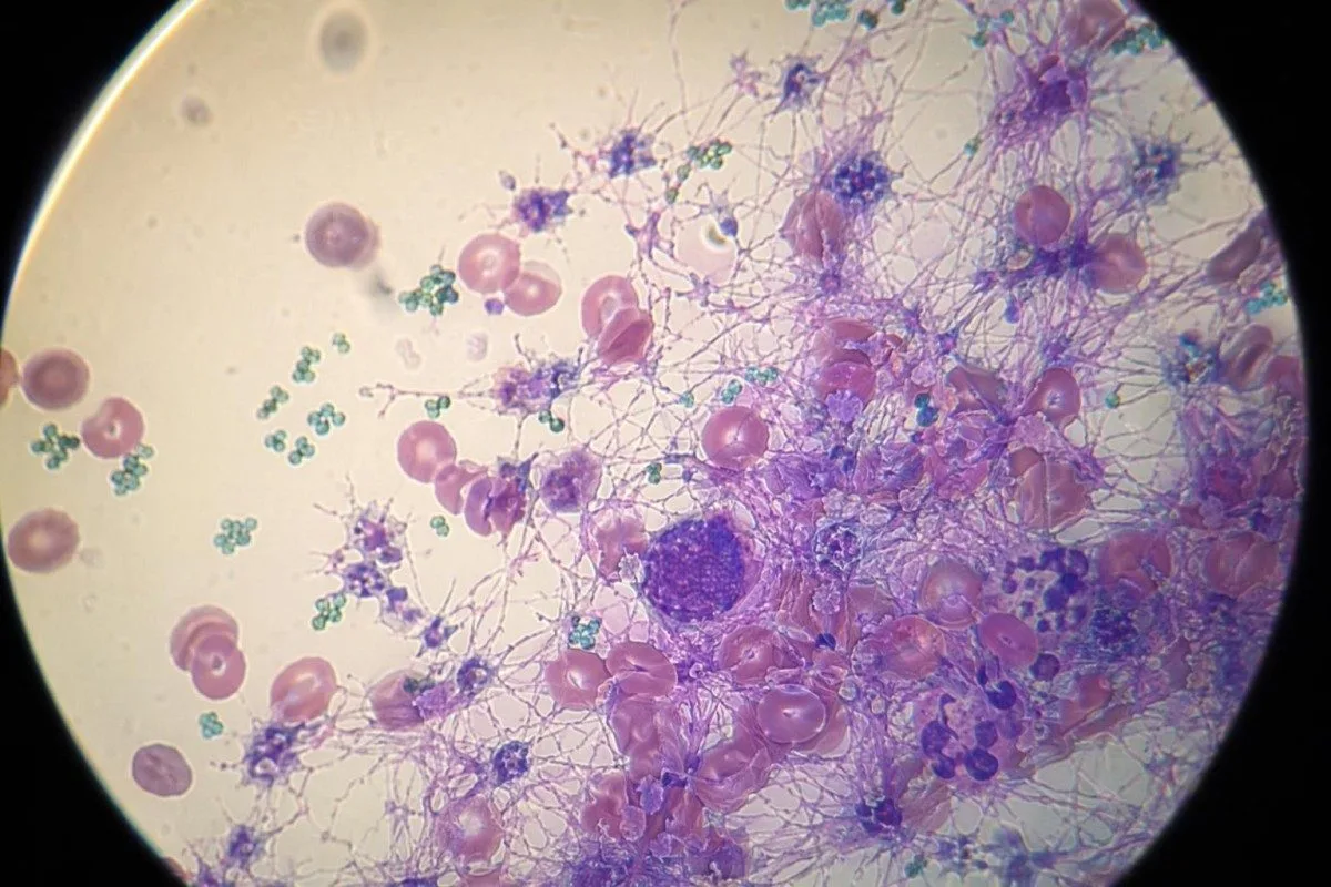 Triaxe de síntomas de anticoagulantes que mostra hematomas, contexto de D-dimer e análises de plaquetas