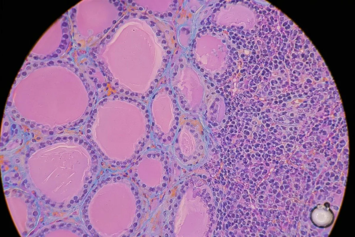 Krvný test na neznášanlivosť chladu prispôsobený pre tehotenstvo, deti a športovcov
