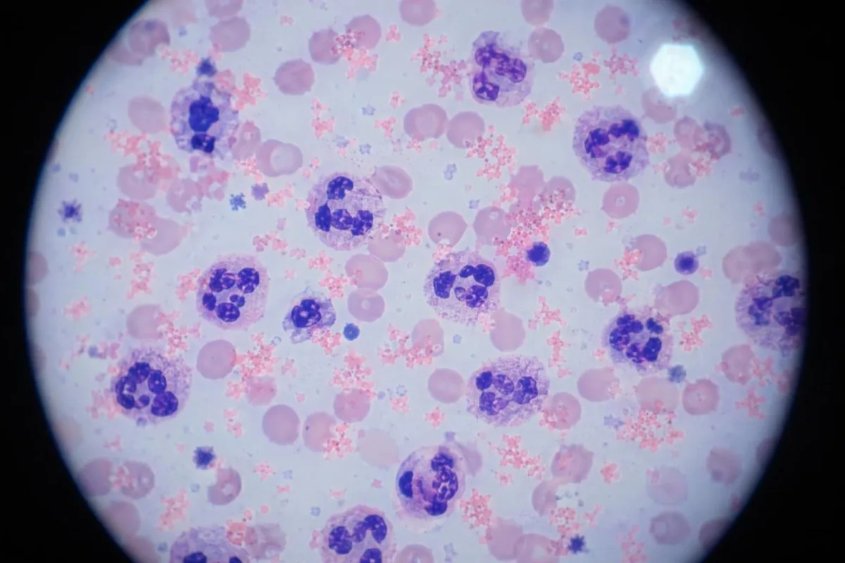 Interpretasyon ng ulat ng blood test ng CRP na may mga yunit at pagkakaiba ng hs-CRP assay