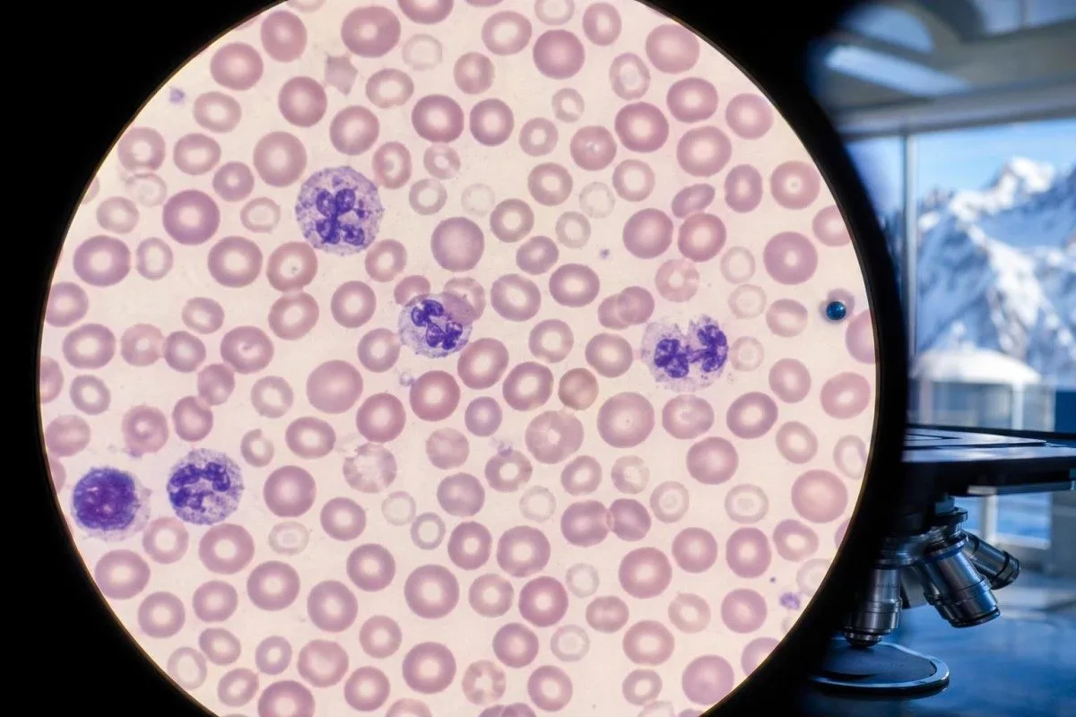 Intervallo normale per il ferro in gravidanza mostrato con elementi cellulari microcitici alla microscopia
