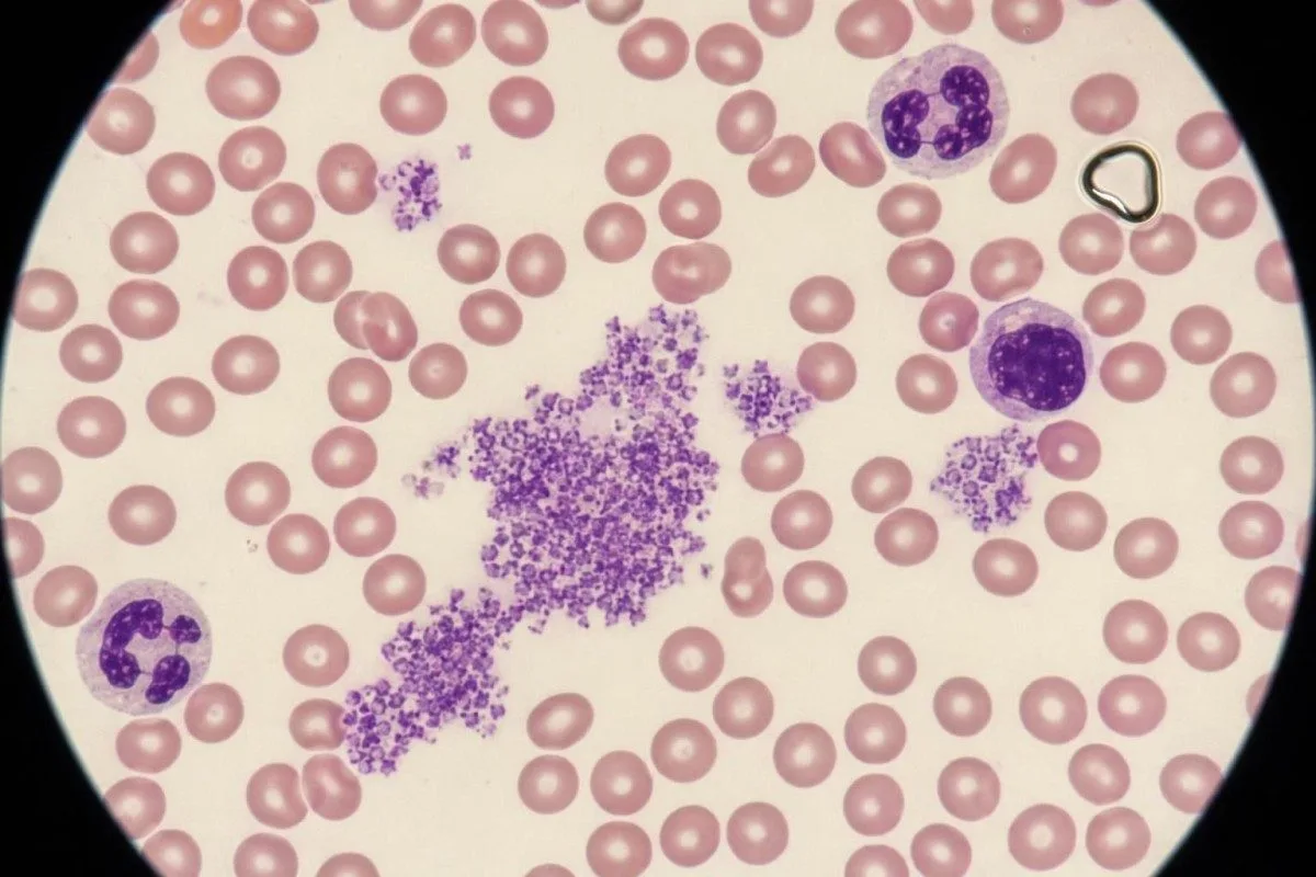 நுண்ணோக்கி ஸ்லைடில் குழம்பிய (clumped) செல்கள் போல காட்டப்படும் platelet எண்ணிக்கை கலைப்பாடு (artifact)