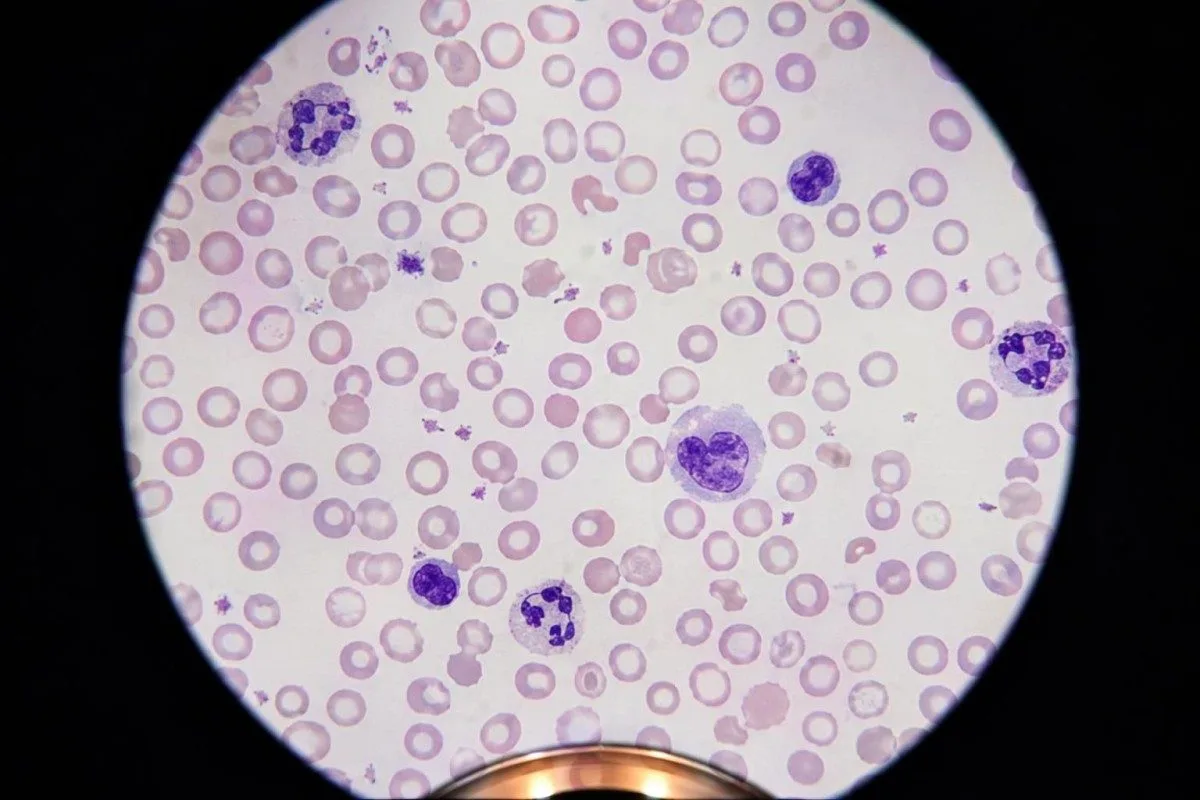 Elementi cellulari dell’esame del sangue preventivo e provette del marcatore del ferro disposte per lo screening dell’anemia