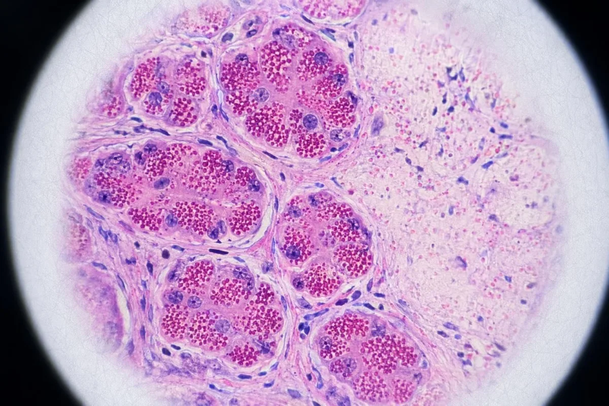 Hulagway sa edukasyon sa pancreatic acinar cell nga nagpasabot sa pagpagawas sa taas nga lipase nga enzyme