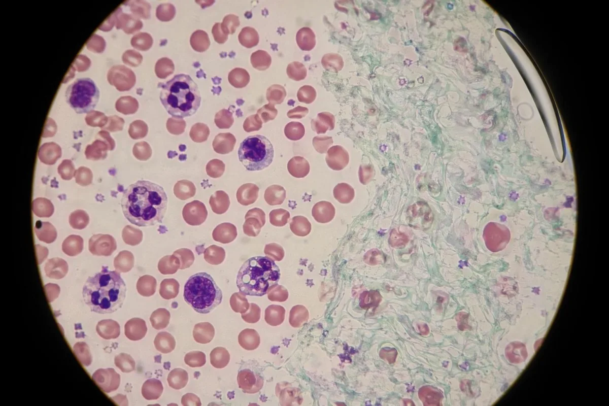 sluz u stolici procijenjena pomoću staničnih obrazaca CBC-a na laboratorijskom stakalcu
