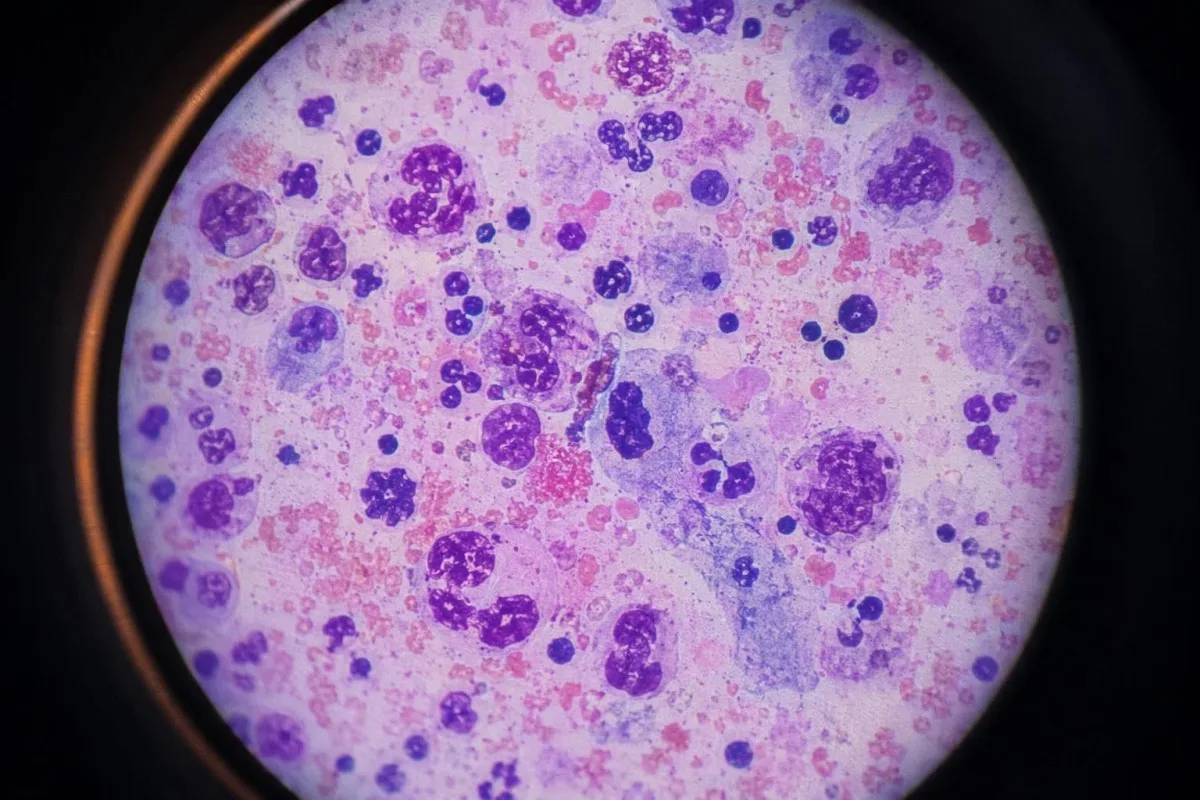 PMS کے لیے خون کا ٹیسٹ، immune response دکھانے والی سیلولر سلائیڈ جس میں inflammatory marker کا سیاق موجود ہو