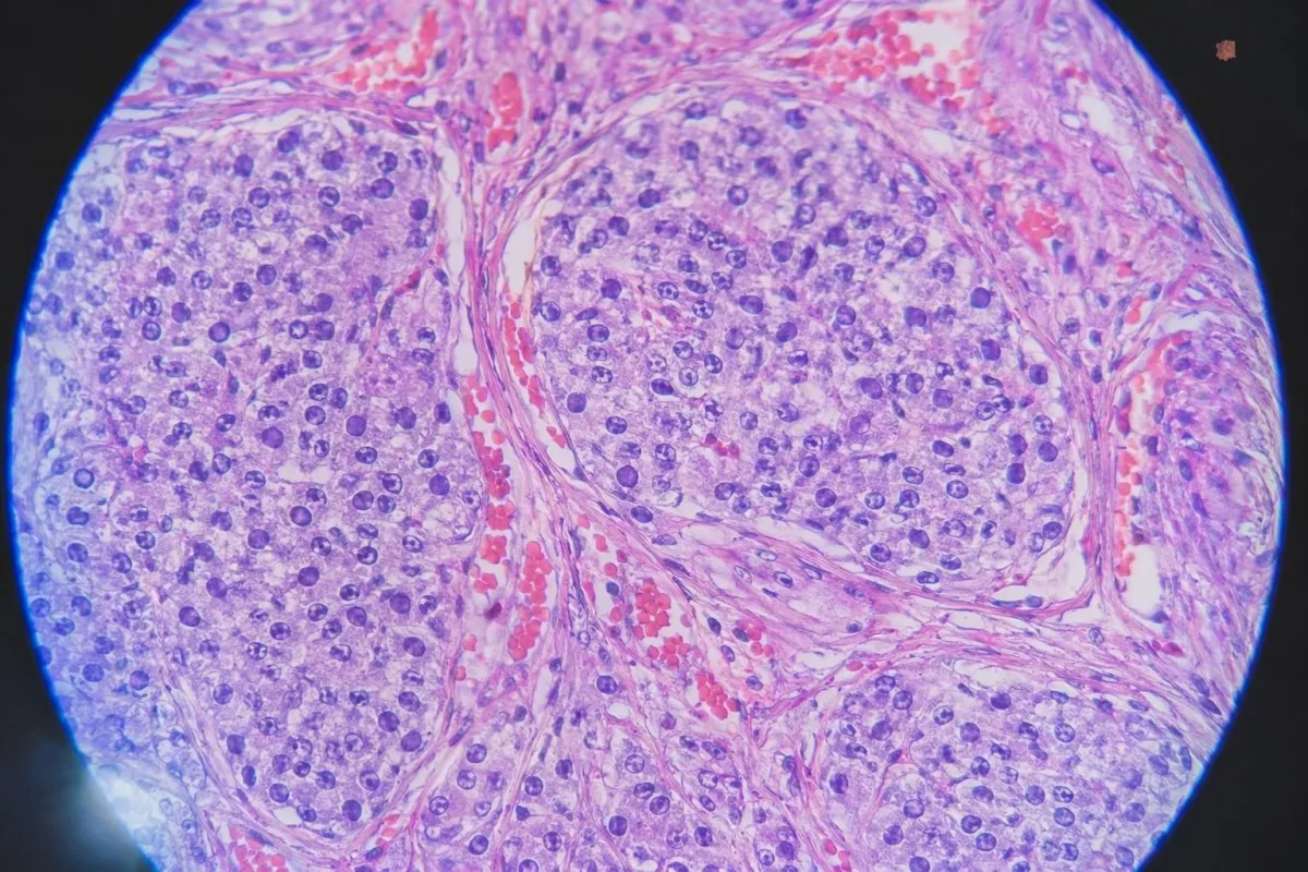 lista kontrolna do badania krwi w kierunku pheochromocytoma z materiałami do ponownego oznaczenia metanefryny