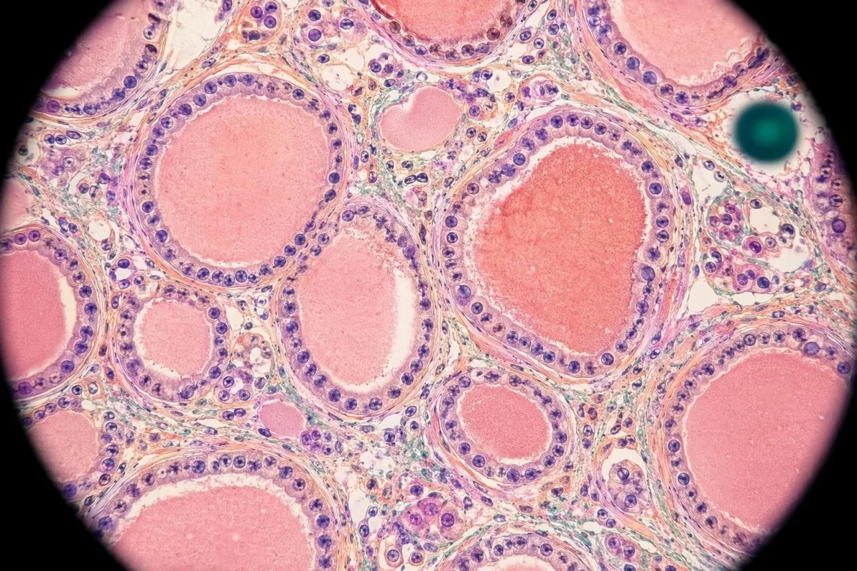 بيماري دوران ٿائيرائيڊ هارمون رستي سان گڏ euthyroid sick syndrome ڏيکاريل