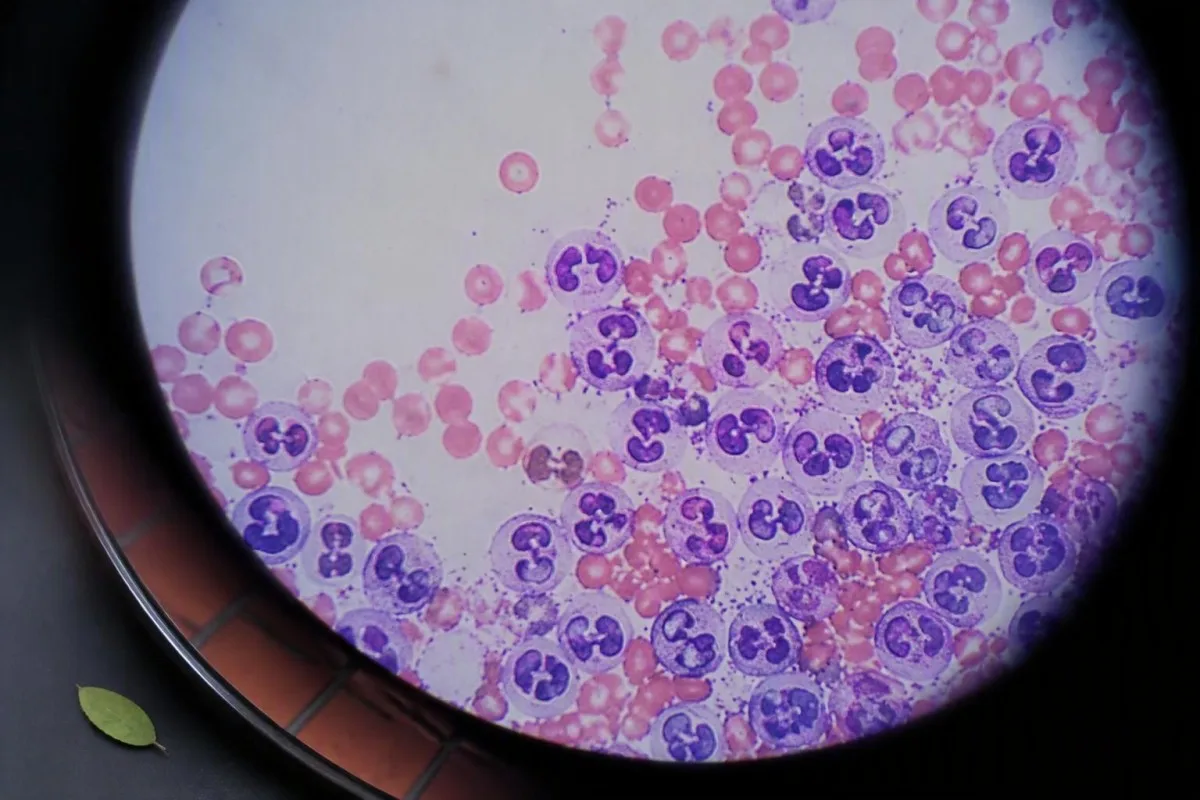 Concept de prise de sang pour cholécystite montrant une coupe transversale de vésicule biliaire à côté d'une analyse d'échantillon de laboratoire