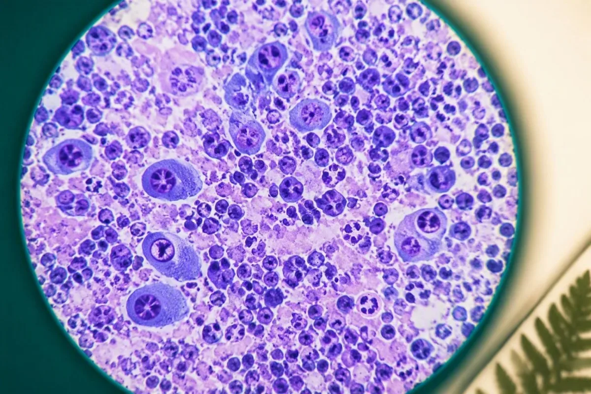 risultati analisi del sangue EBV accanto a scarpe da ginnastica e un piano di ritorno all'attività guidato dal clinico