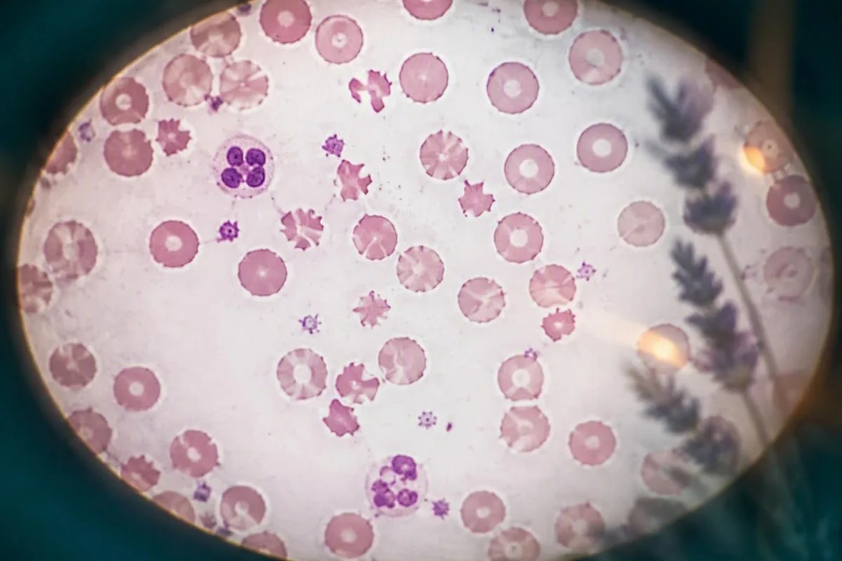 HELLP-syndromets laboratorievärden illustrerade av ett anatomiskt levertvärrsnitt med markörer för enzymaktivitet