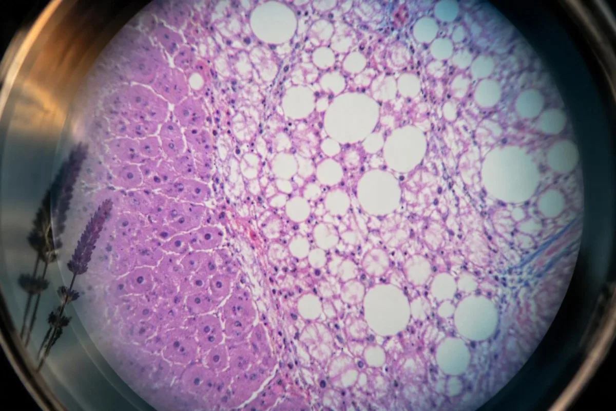 Metabolikus diszfunkcióval társult steatótikus májbetegség tesztelési előkészületek éhgyomri időzítővel és laboratóriumi mintacsomaggal