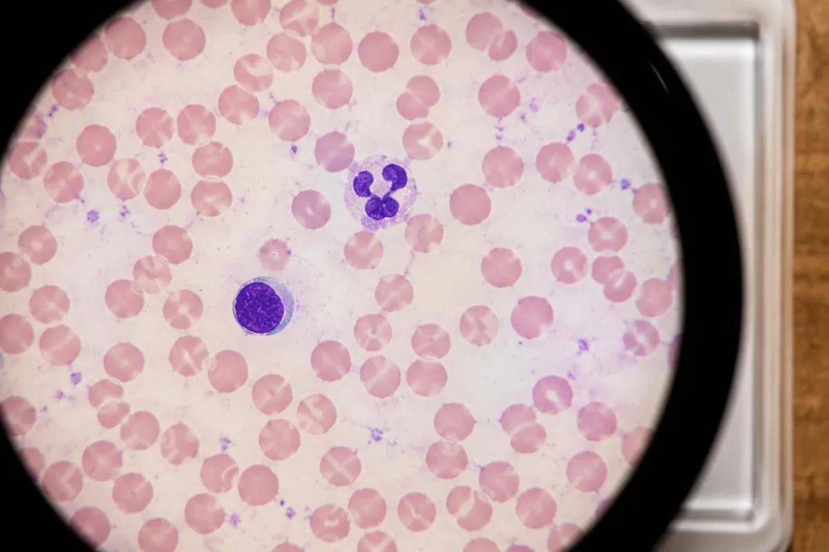 Cell sample slide showing neutrophils and other cellular elements during investigation of a low ANC